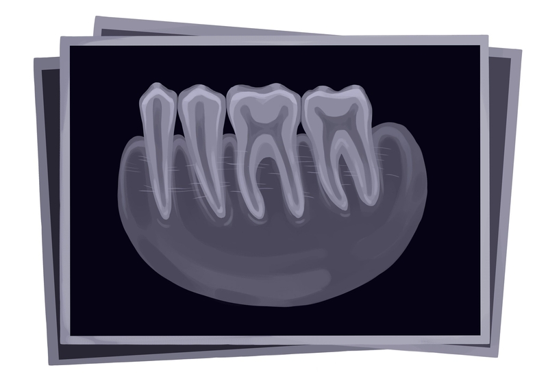 Dental x-ray showing dental abscess