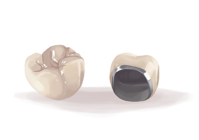  Porcelain fused to the metal PFM dental crown