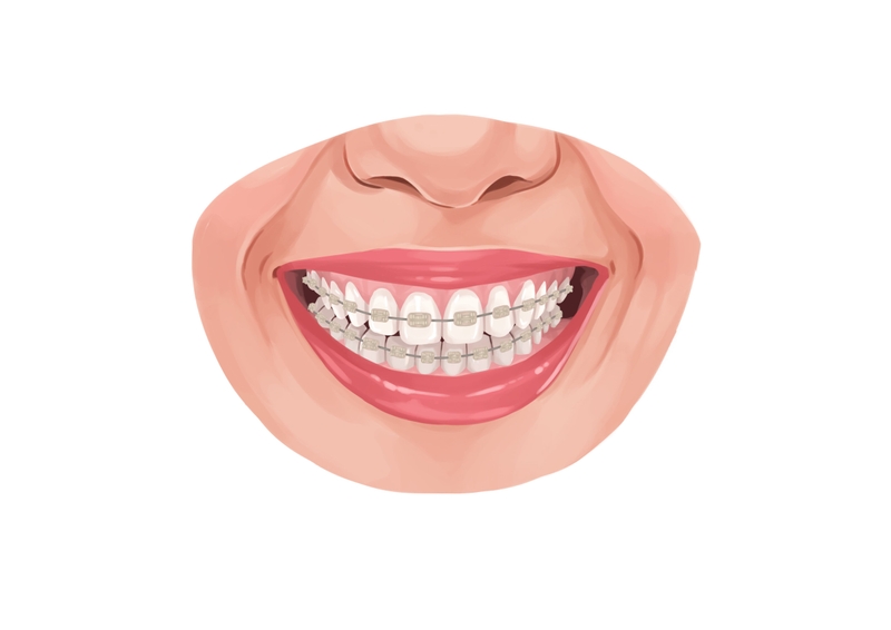 Ceramic dental braces