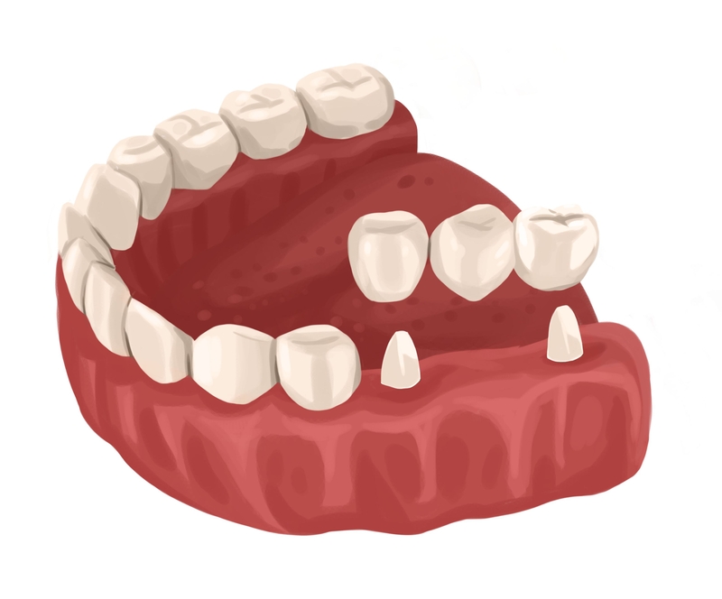 Traditional dental bridge 