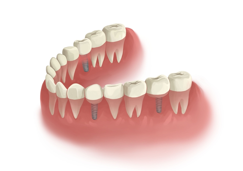 Three single implants in parts lower arch