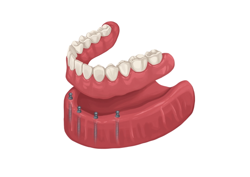 Snap in denture on mini dental implants