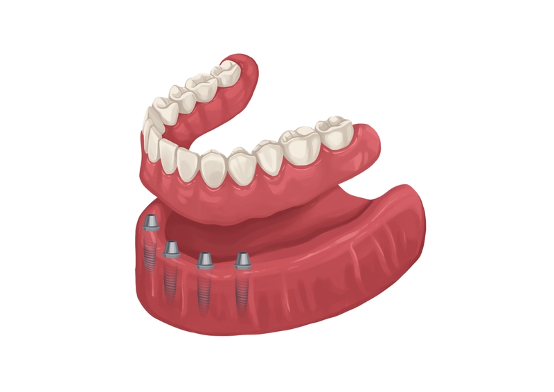 Fixed implants denture lower arch