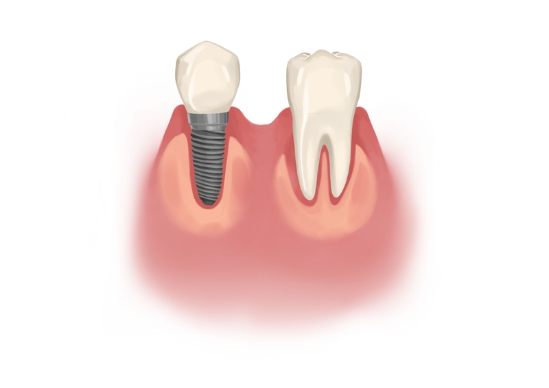 Single dental implant next to natural back tooth