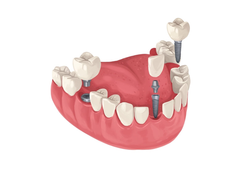 Three single implants on the lower arch