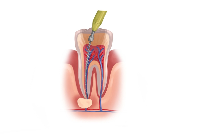 root canal process explained