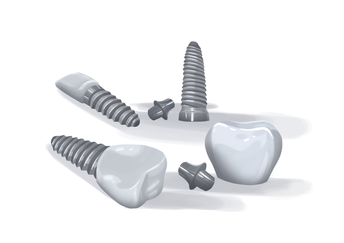 Can you get affordable dental implants in 2024? Authority Dental