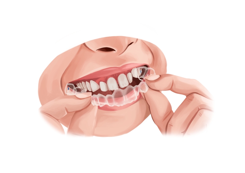 Invisalign aligner for diastema treatment