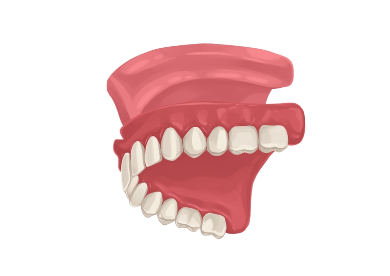 Full upper dentures with palate
