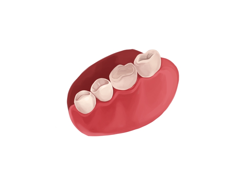 ceramic dental filling