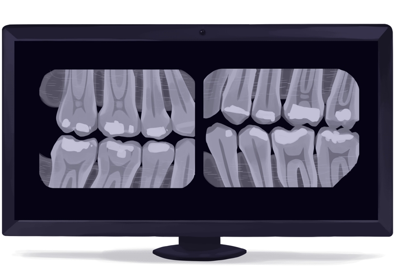 Bitewing dental x-ray digital