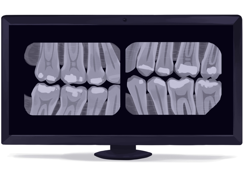 Bitewing dental X-ray