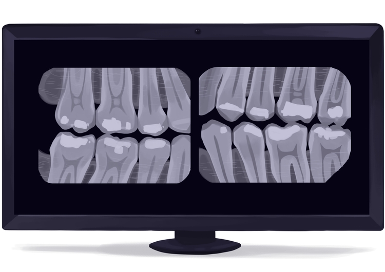 Scaling and Root Planing (SRP): What It Is, Procedure, Pain & Recovery ...