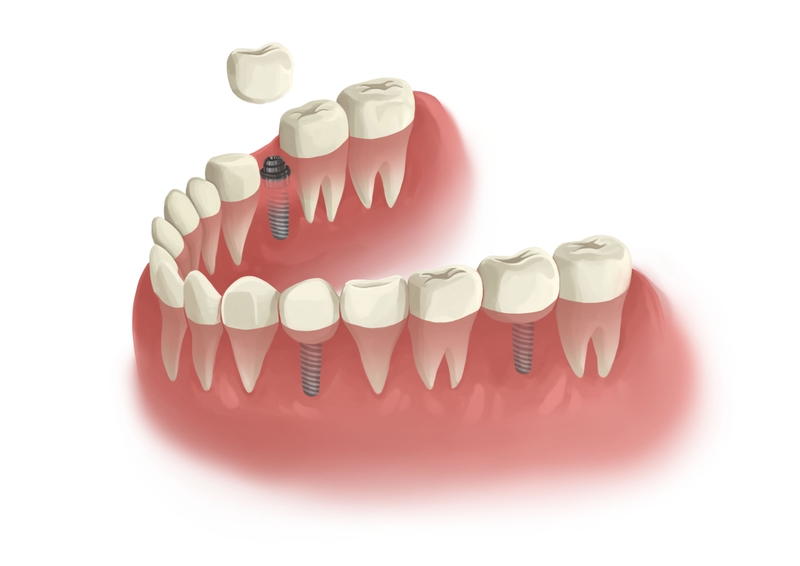 Implant in parts lower arch 