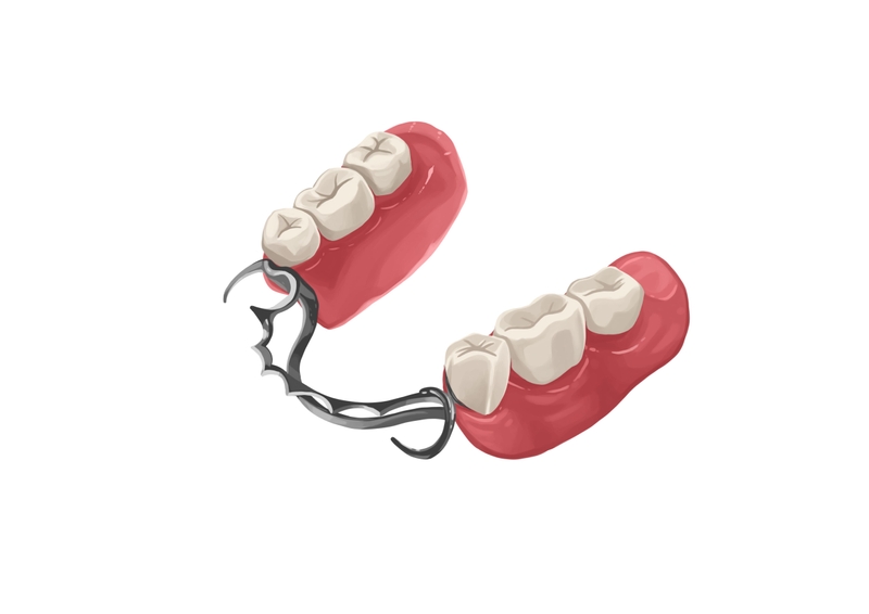 Metal partial denture for lower arch