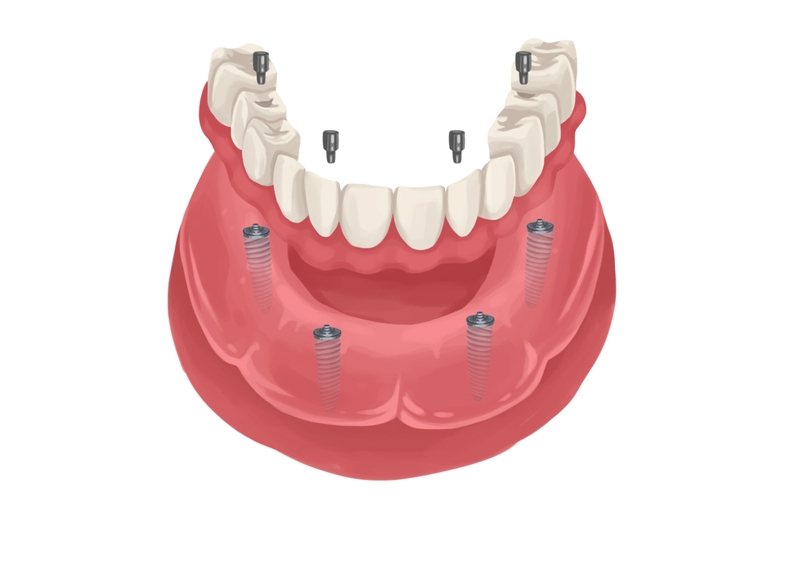 Implant supported denture lower arch