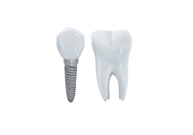 dental implants are alternative to root canal treatment