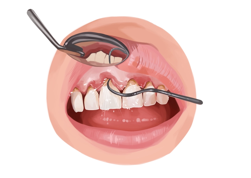 Scaling and root planing treatment