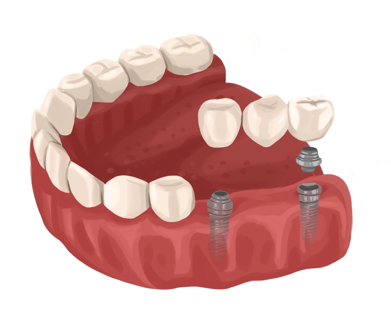 Implant supported dental bridge