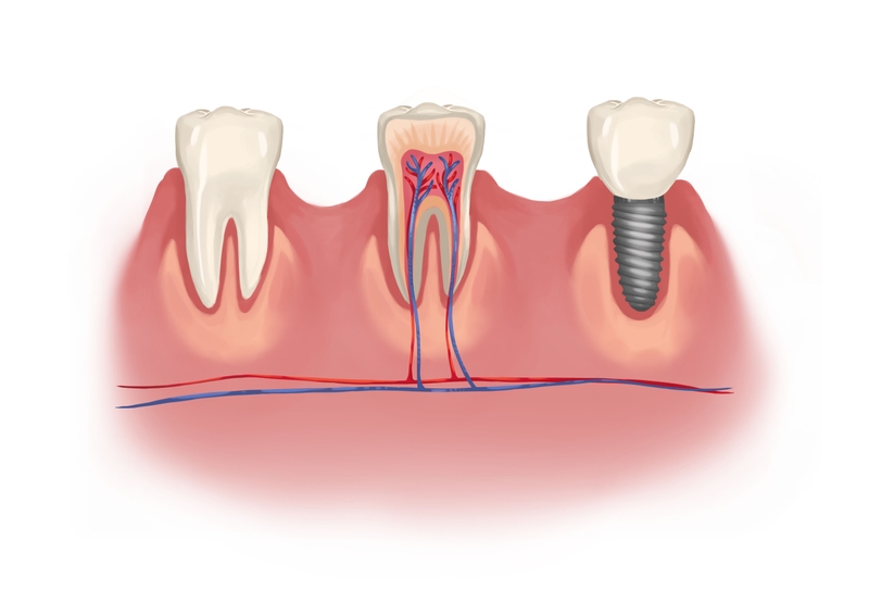 Dental implant vs. natural tooth with nerves