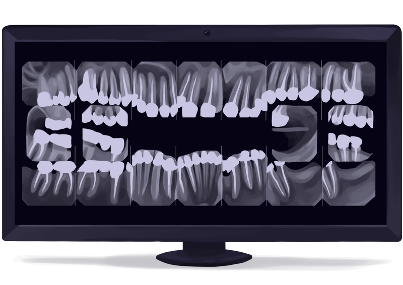 Full mouth dental X-rays