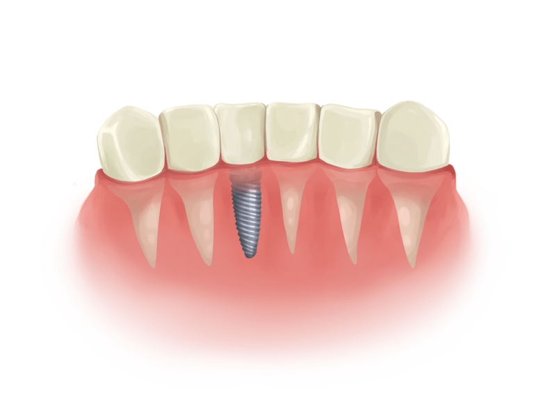 Single dental implant next to natural teeth