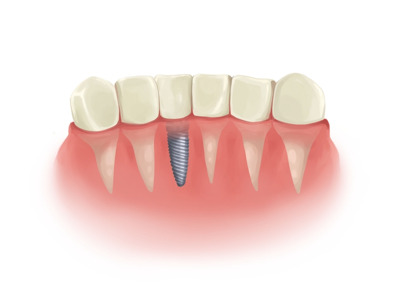 Full mouth dental implants