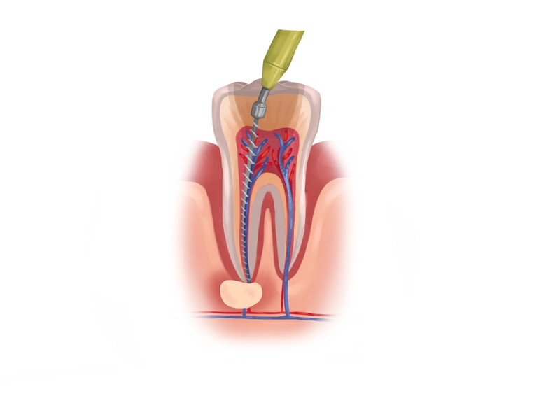 Root canal treatment