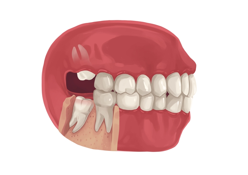 Partially bony wisdom tooth