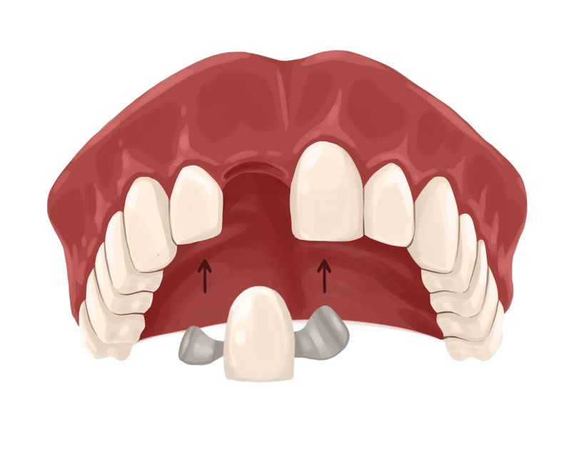 Maryland dental bridge