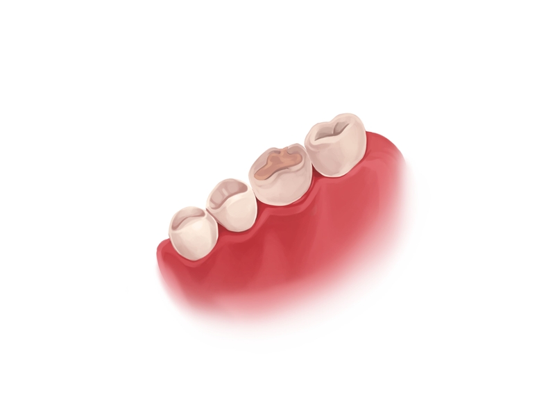 Composite dental filling