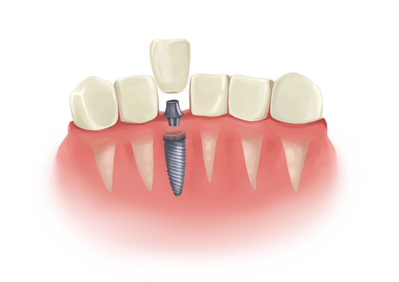 Single dental implant in parts next to natural teeth