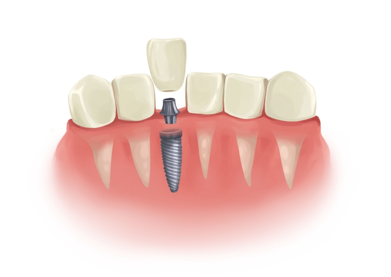 Single dental implant in parts next to natural teeth 