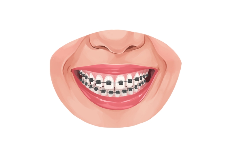 Self-ligating braces