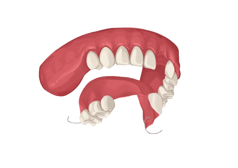 Interim partial dentures for upper arch