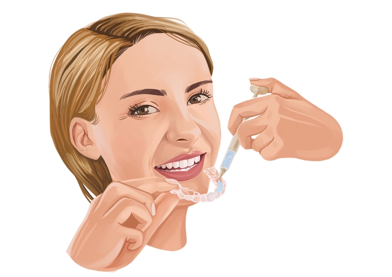 Teeth whitening with custom trays and gel