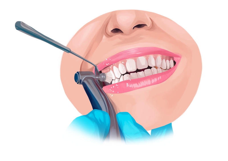 Professional teeth cleaning