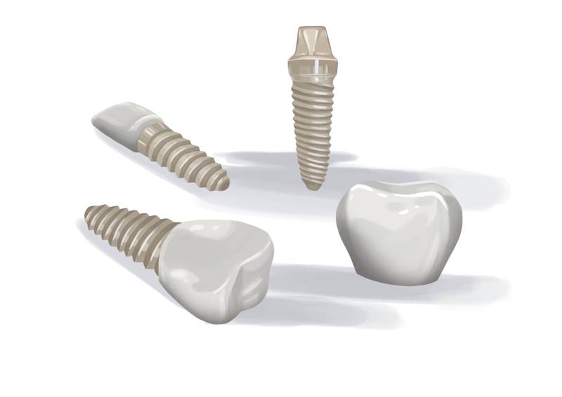 Mix of zirconia dental implants