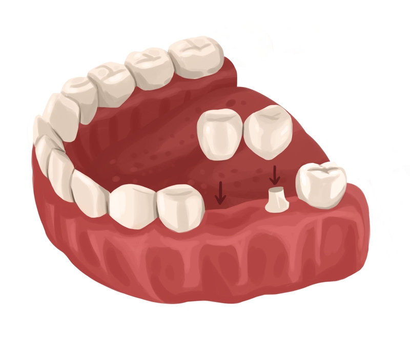 Cantilever dental bridge