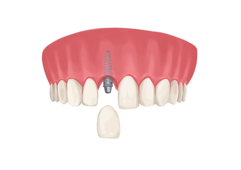 Front tooth implant 