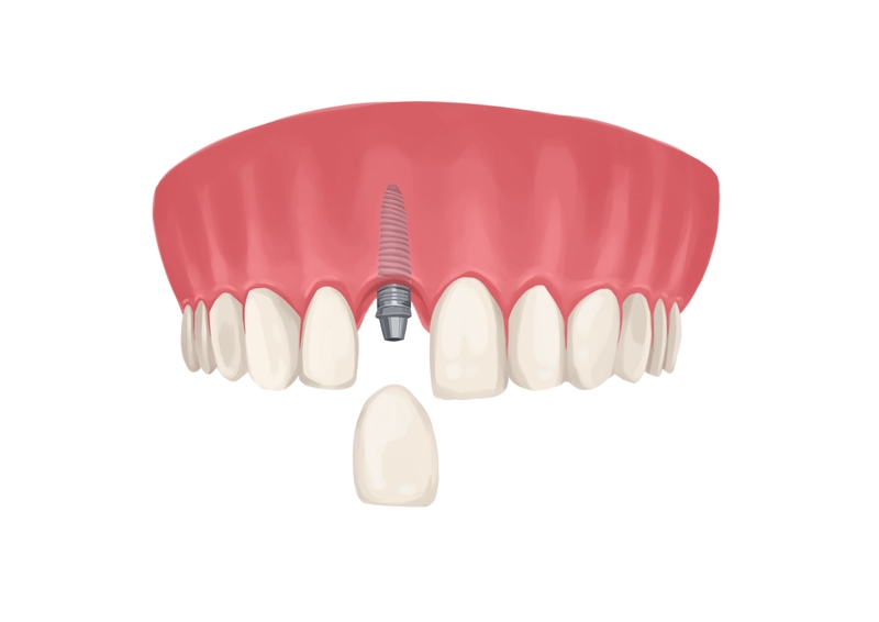 Front tooth implant