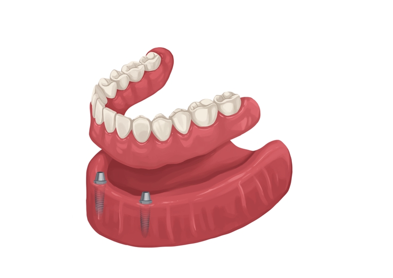 Removable denture implants