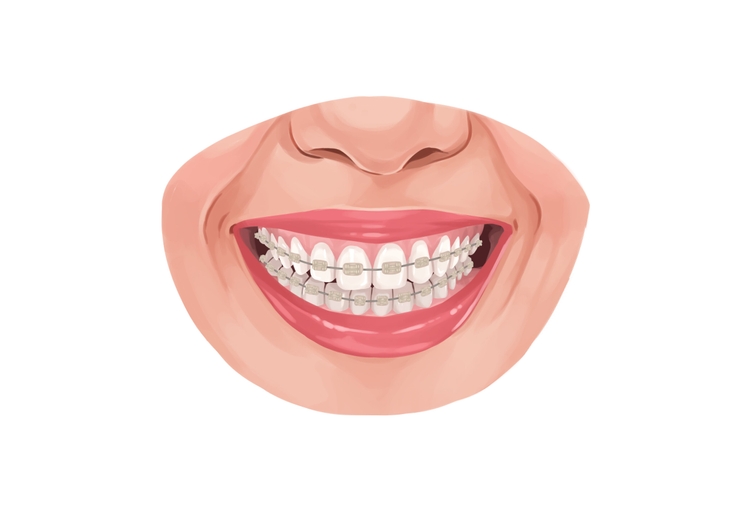 How much do braces cost in 2024? Authority Dental