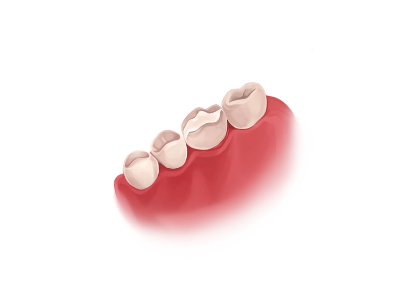 Temporary dental filling