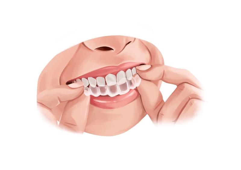 Invisalign aligner