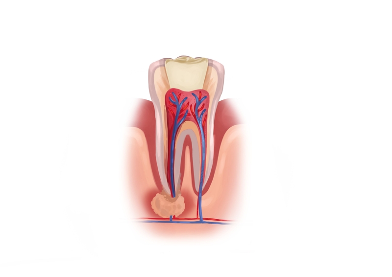 When is a root canal necessary?