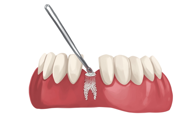 Dental bone graft