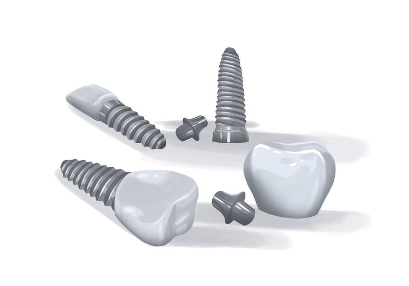 Dental Implants Services