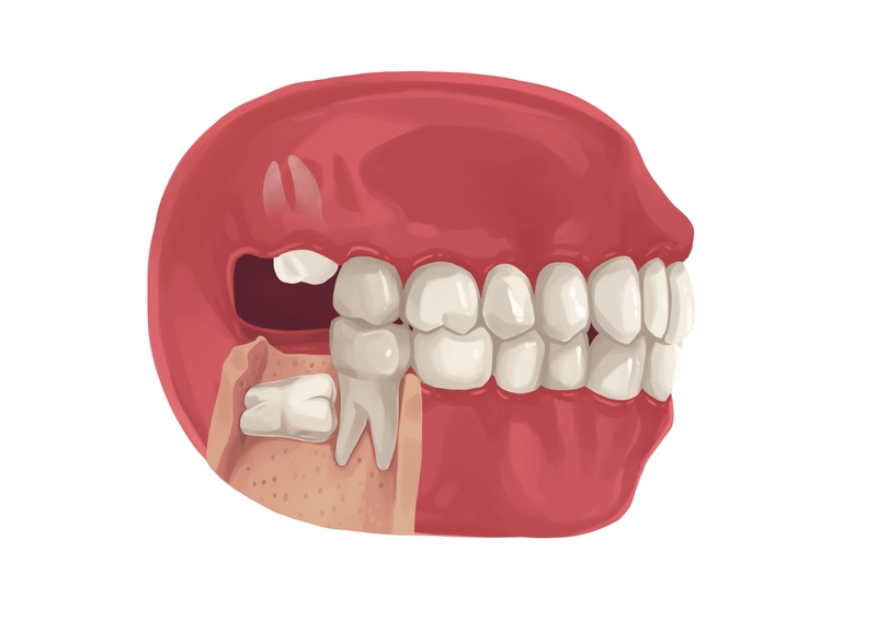 Wisdom tooth fully bony impaction