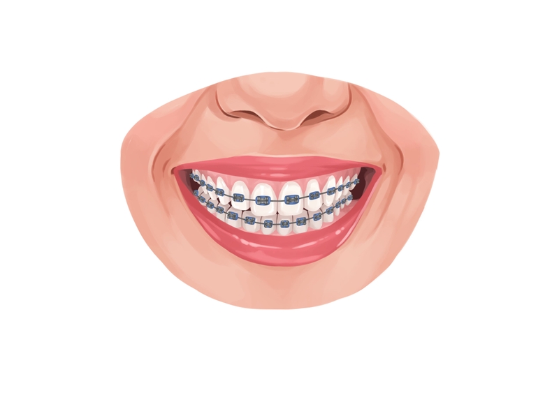 How much do braces cost in 2024?